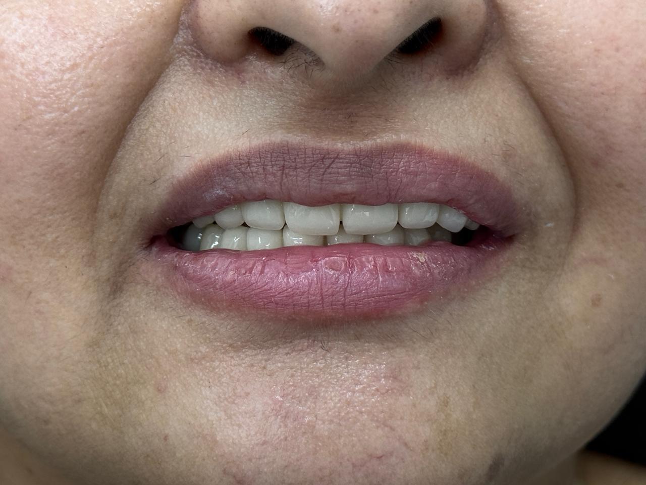 Full mouth rehabilitation: Severely attrited teeth restored with multiple root pins and zirconium crowns treatment